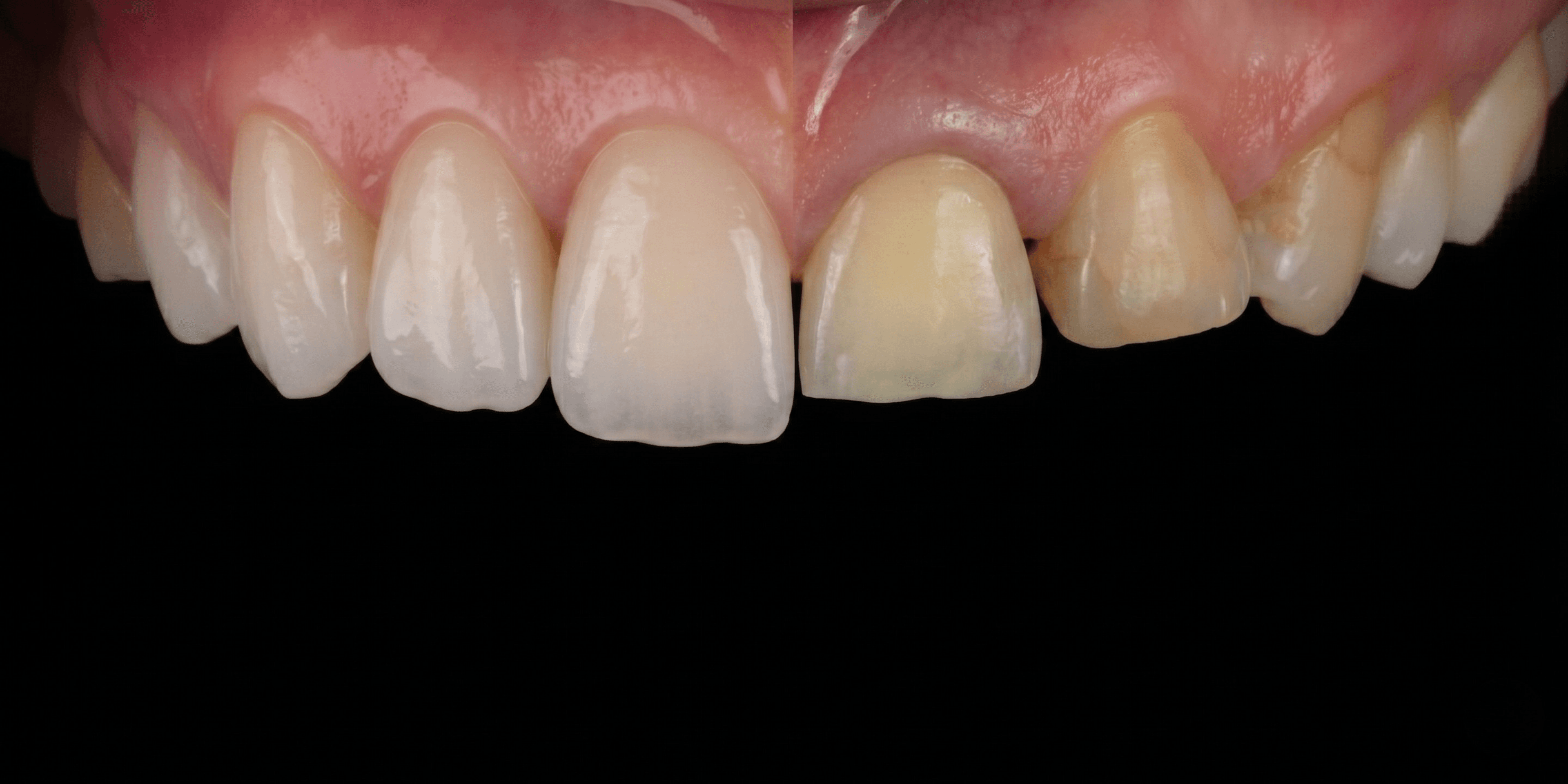 Before and after dental transformation